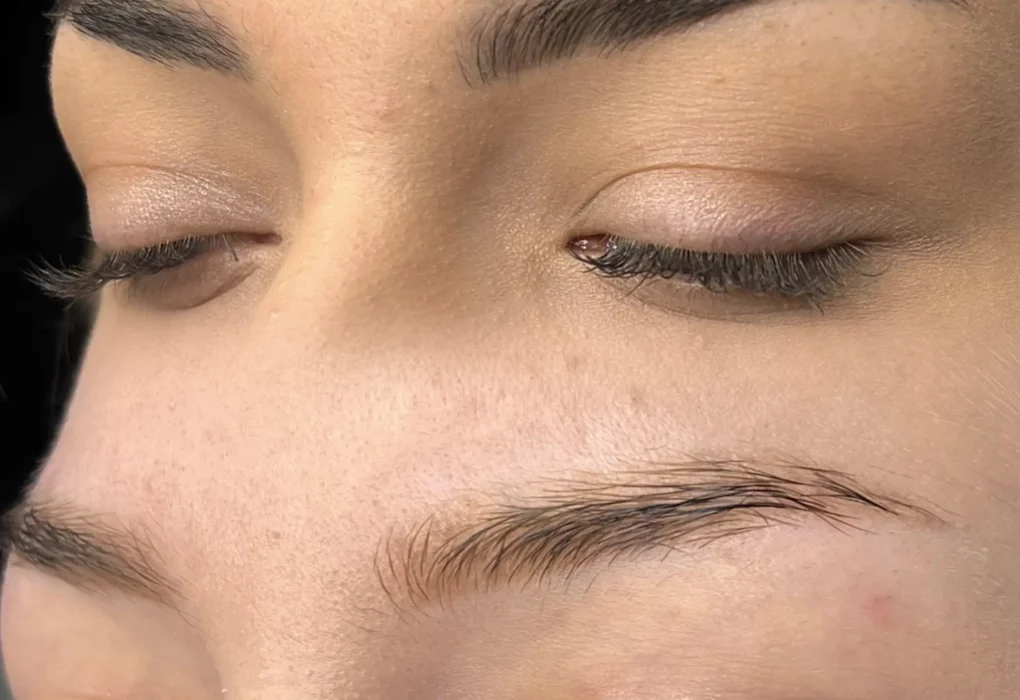 eyebrow tattoo removal