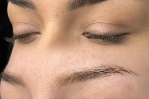 eyebrow tattoo removal