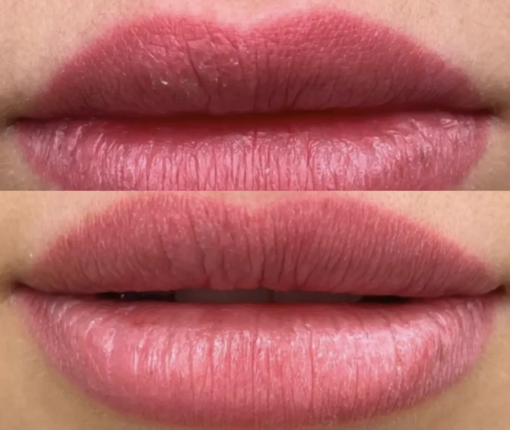 lip saline tattoo removal