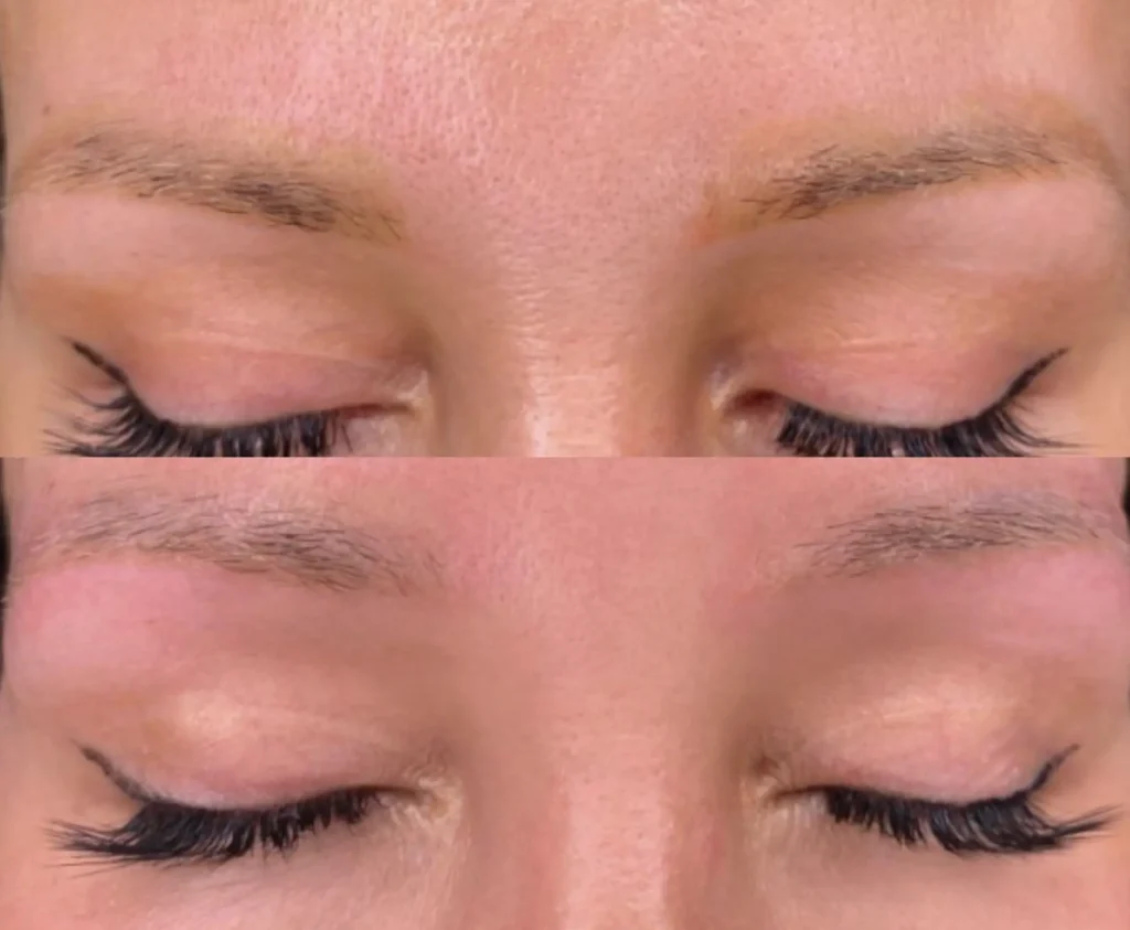 saline eyebrow tattoo removal before and after
