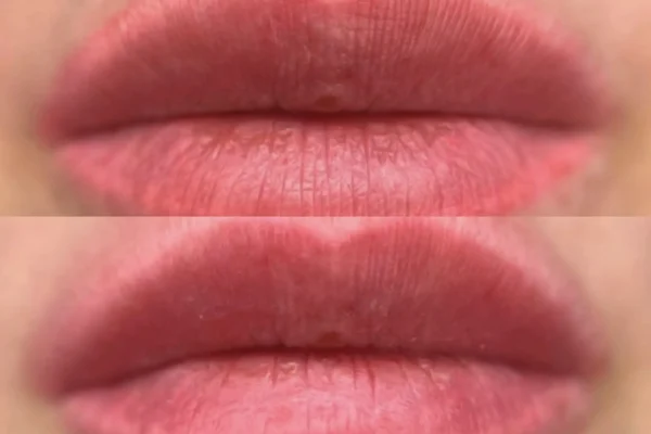 saline tattoo removal