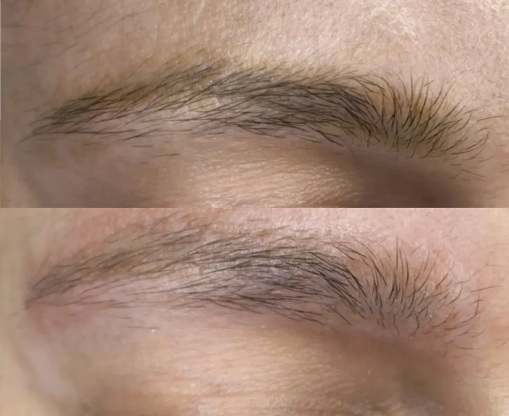 saline tattoo removal before and after