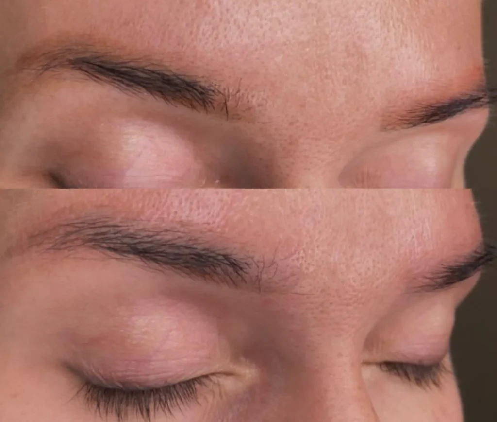 saline tattoo removal healing process