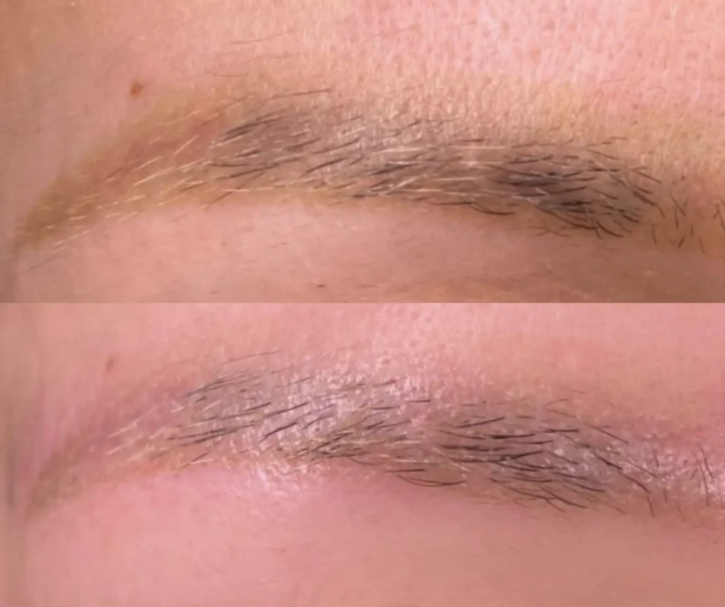 saline tattoo removal melbourne