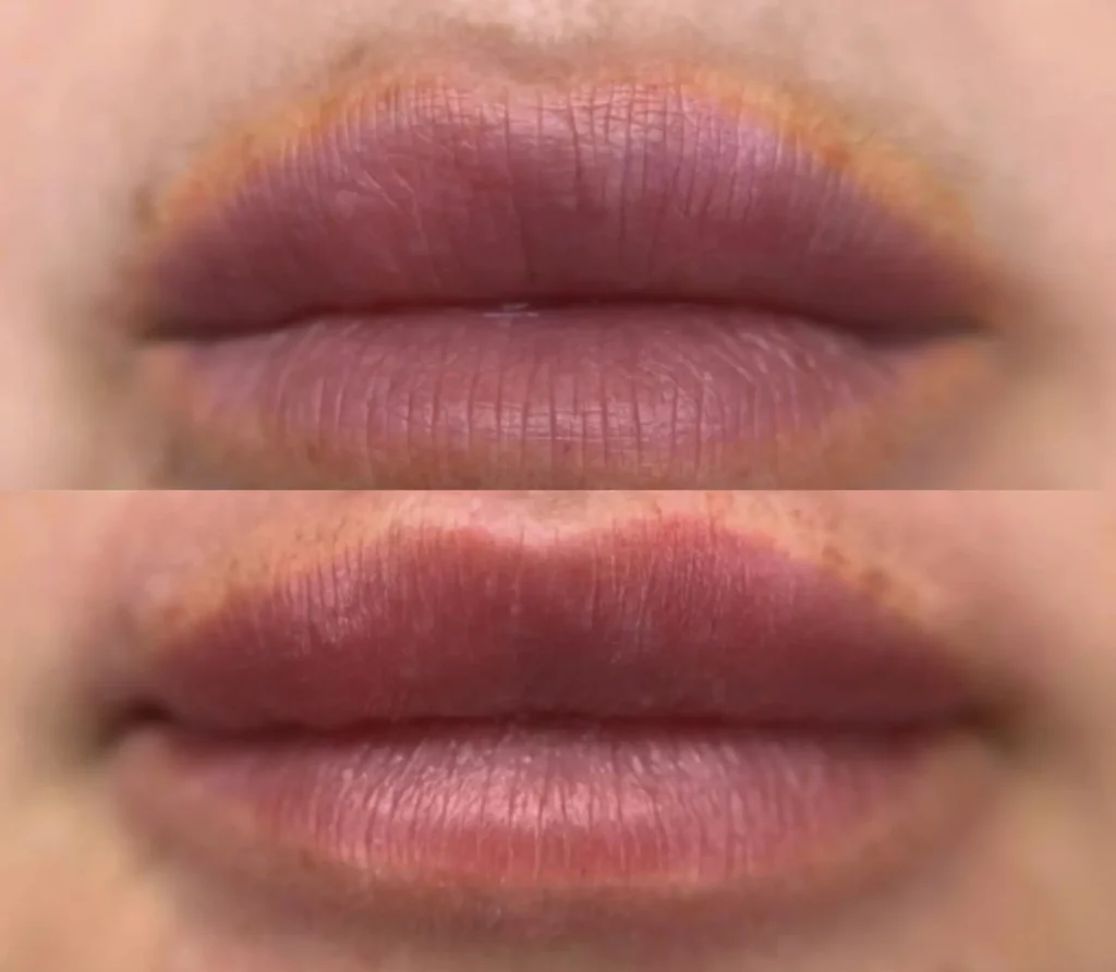 salt and saline tattoo removal before and after